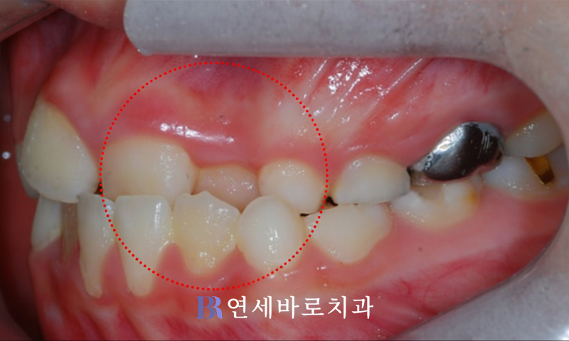 대전 노은동 치과, 어린이 교정은 몇 살부터 시작해야 할까요? (소아 치아교정 진료 후기)