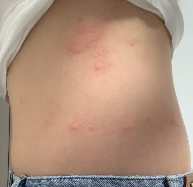갑자기 두드러기 간지러움 때문에 잠 못 든다면? 원인과 대처법