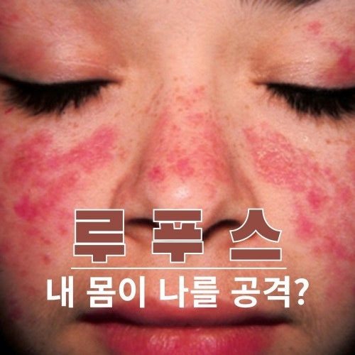 루푸스 증상과 원인, 전신홍반루푸스 검사로 확인하는 방법까지