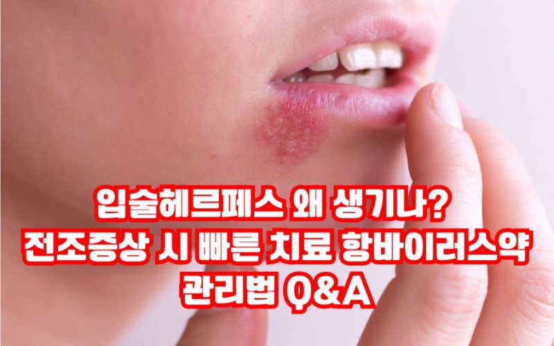 입술헤르페스 왜 생기나? 전조증상 시 빠른 치료 항바이러스 약, 관리법 Q&A