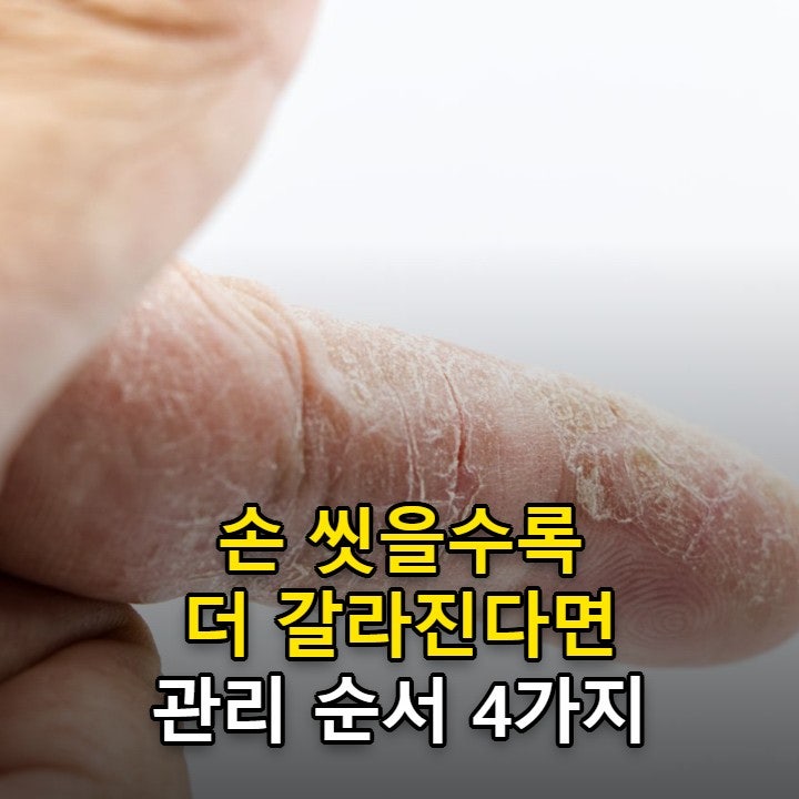 손 습진 원인, 물 닿을수록 갈라지는 손이 낫지 않는 이유와 관리 순서