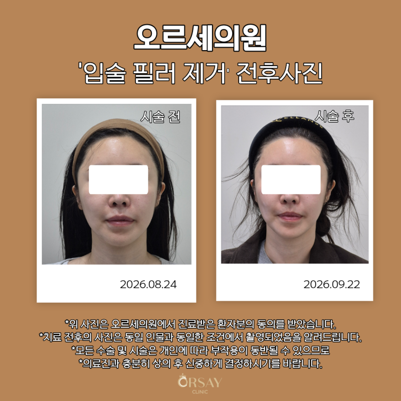 충정로피부과 입술 필러 녹이기,녹였는데도 튀어나와 보였던 이유