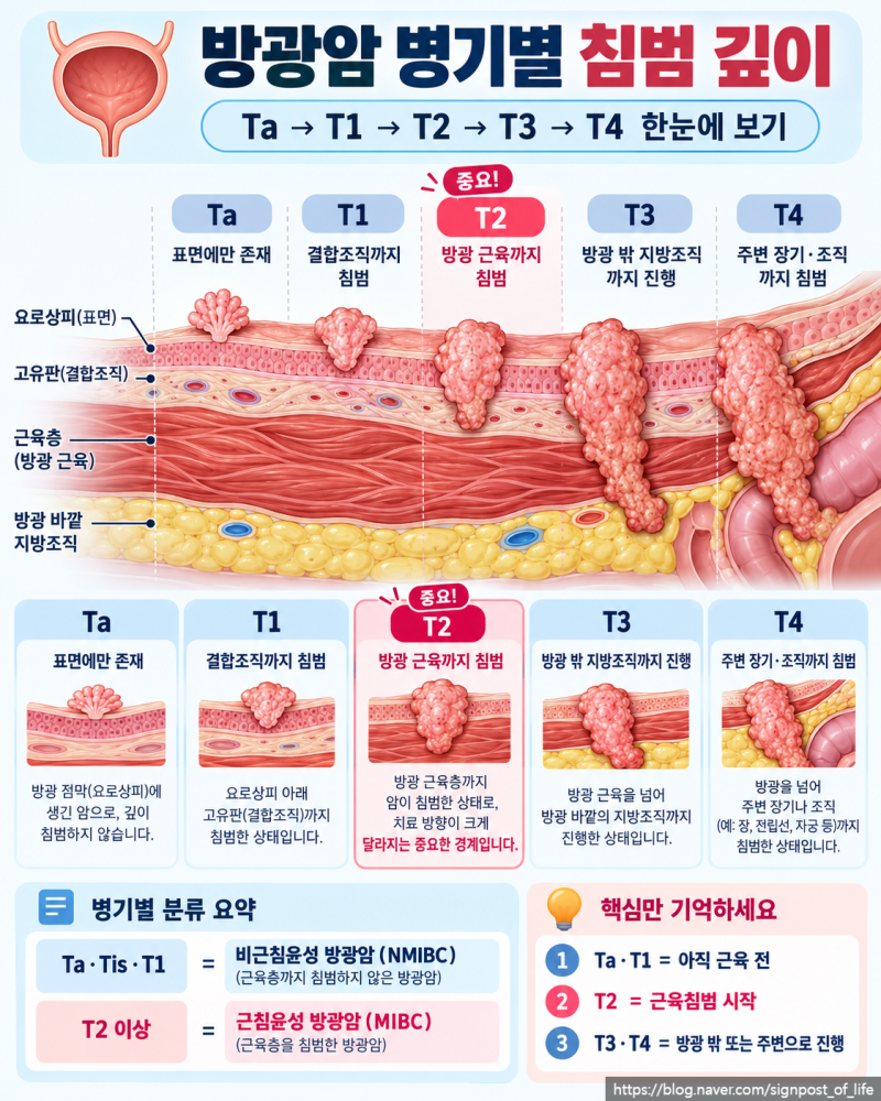 방광암 병기 Ta·T1·T2·T3·T4, 얼마나 진행된 걸까?