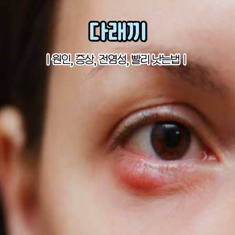 눈 속 다래끼 원인 증상 전염성 다래끼 빨리 낫는법