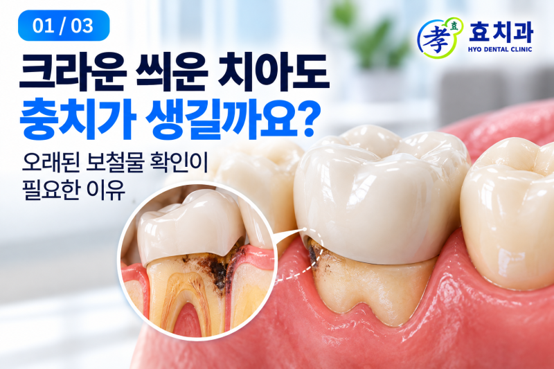 크라운 씌운 치아도 충치가 생길까요? 오래된 보철물 확인이 필요한 이유