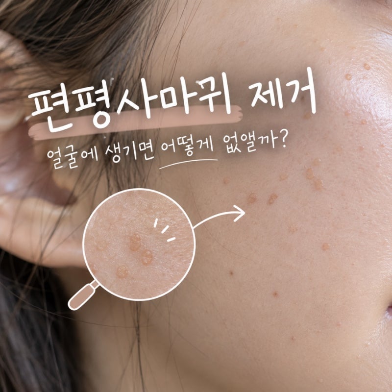 편평사마귀 원인 및 제거, 얼굴에 생기면 어떻게 없앨까?