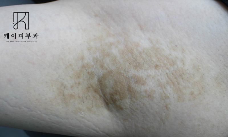 부산 레이저제모 부작용, 염증 후 색소침착 치료 (겨드랑이)