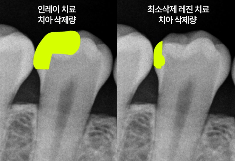 청주 충치치료, 같은 레진인데 왜 비용이 이렇게 다를까요?