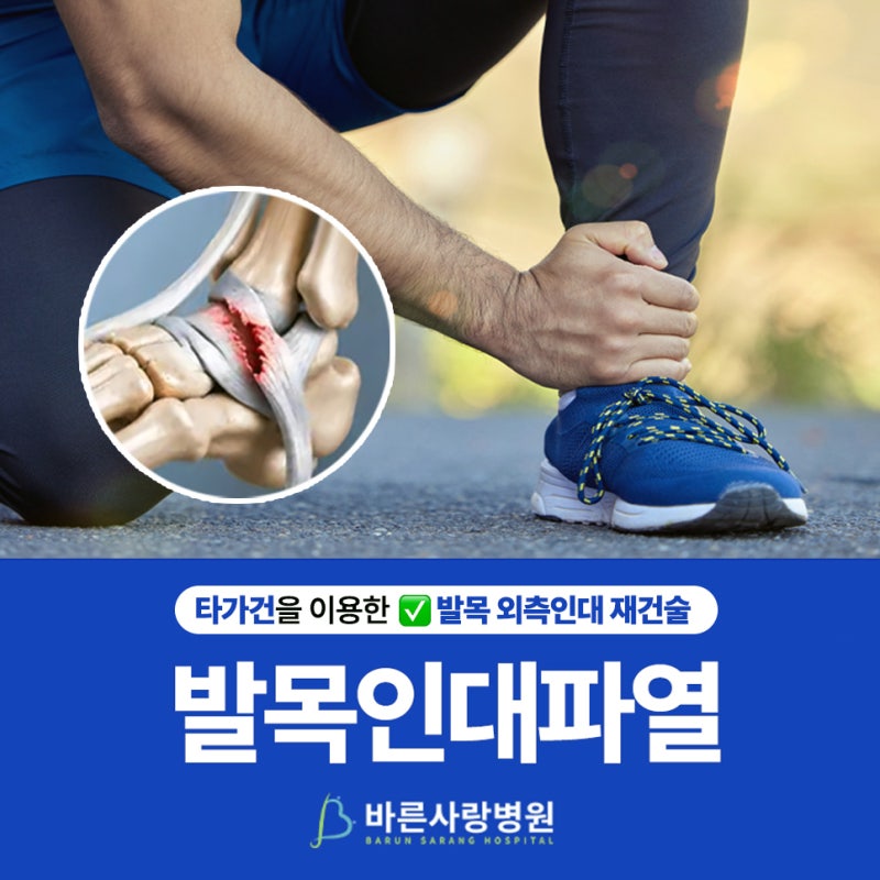 발목인대파열, 치료 방법은 어떻게 결정할까요? ✅ 발목 외측인대 재건술 알아보기 | 바른사....