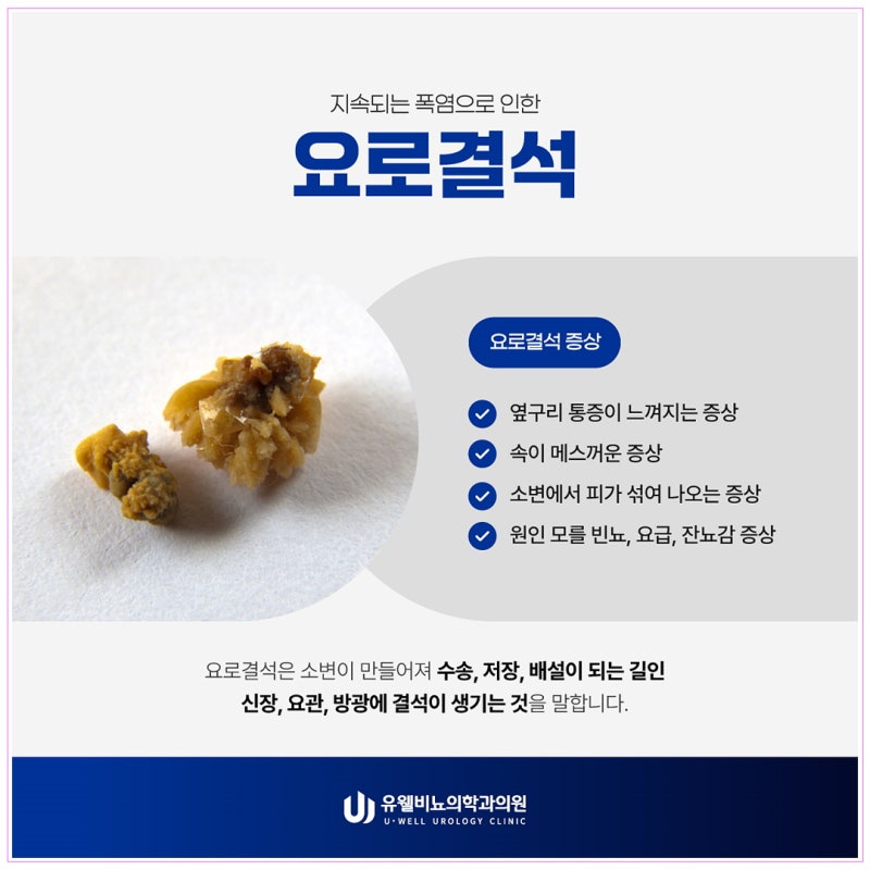 강남역비뇨기과 신장결석 치료 자메닉스에 대해