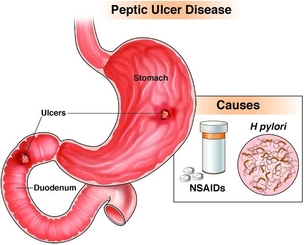소화성 궤양 Peptic ulcer: 속이 쓰린 밤, 위는 왜 자기 자신을 소화하지 않았을까요?