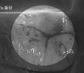 비정형편평상피세포의 원인, 자궁경부암 고위험군 HPV 감염 때문일까요?