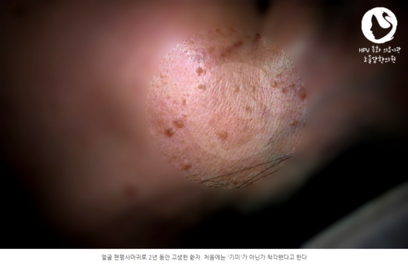 편평사마귀 레이저 치료 후 자꾸 재발하고 번지는 원인은 무엇일까요?
