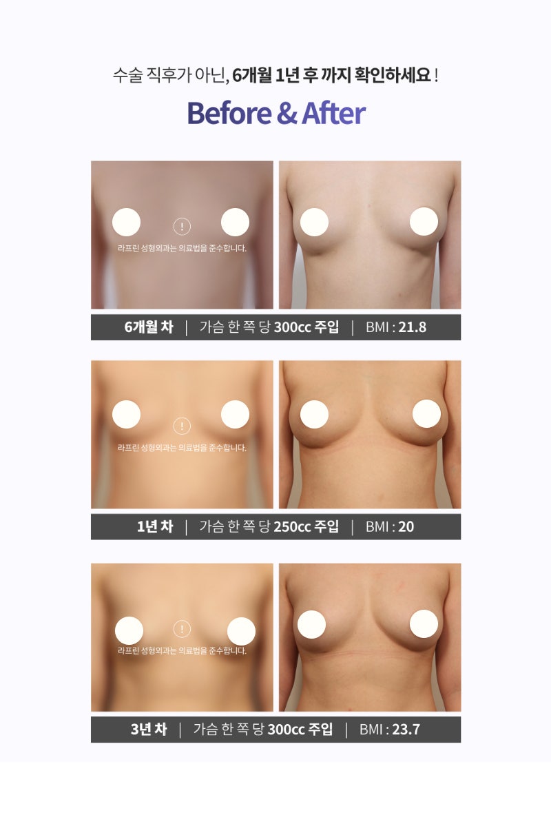 라프린의원 가슴지방이식, 300cc? 생착률과 주입량에 대한 궁금증
