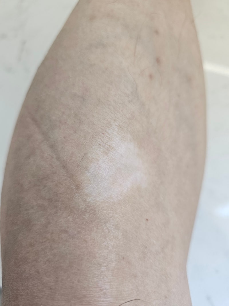 갑자기 생긴 피부 변색, 백반증? AI 분석과 증상 총정리