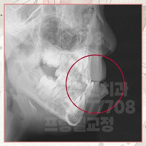 주걱턱 교정기, 만 5세 전후에 시작해야 하는 이유