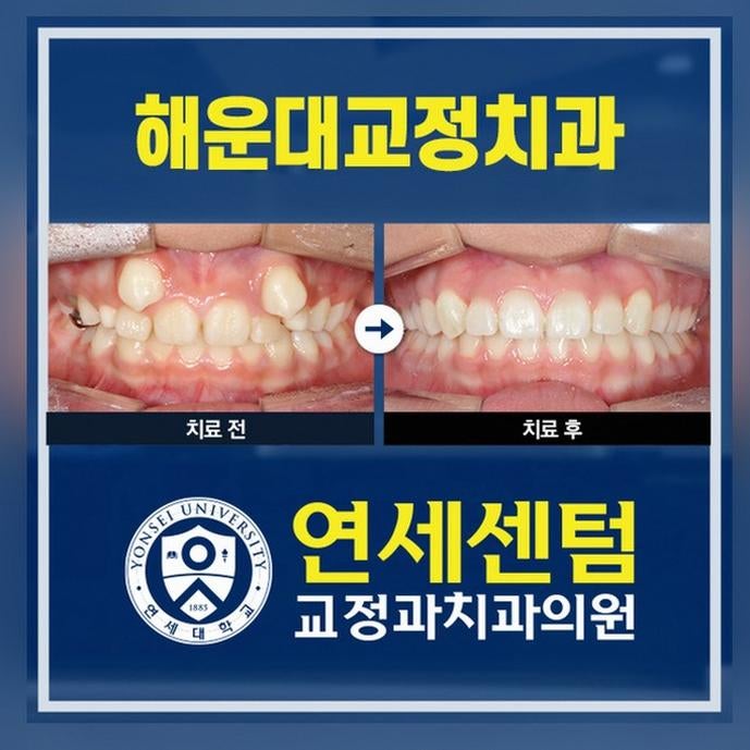 해운대교정치과 덧니교정 치료 과정과 비용 선택 기준 정보