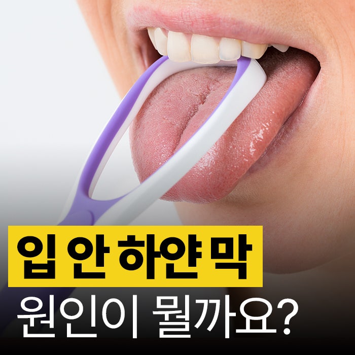입 안쪽 하얀 막 원인, 칸디다증과 백반증 차이점 확인해요