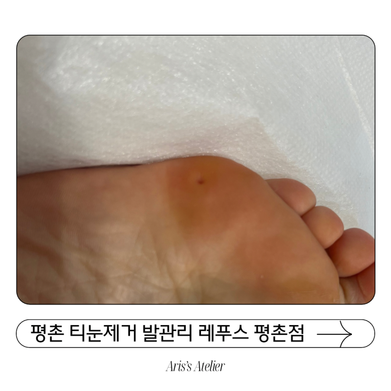 평촌 티눈제거 레푸스 평촌점, 통증 없이 관리받은 후기