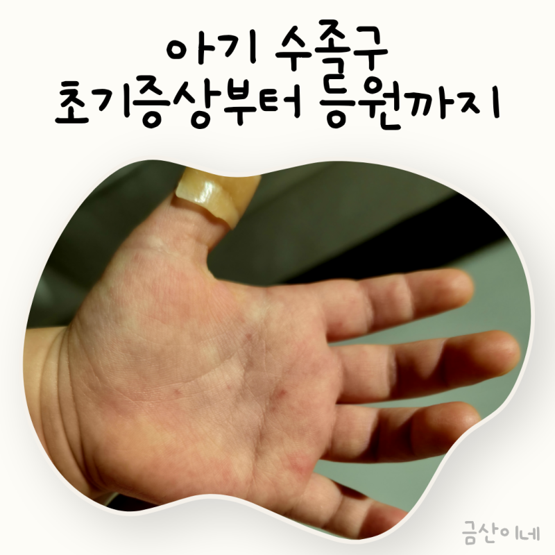 아기 수족구 초기증상 3가지 완치까지 겪은 후기
