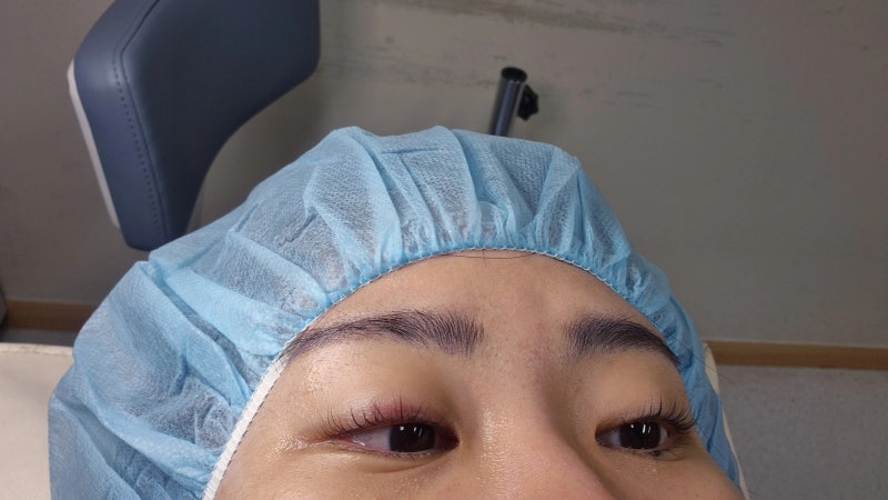 [혜민안과병원] 묵은 다래끼 두개 째기... 엉엉슨