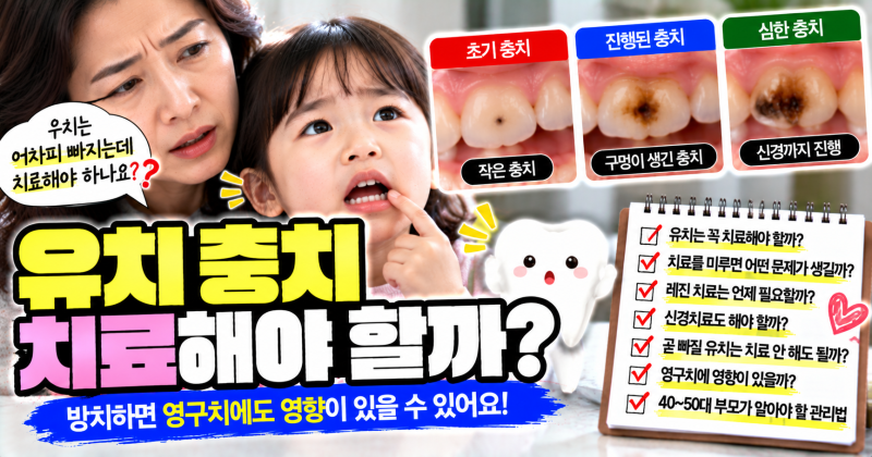 유치 충치 치료해야 할까? 어차피 빠질 치아인데 꼭 치료해야 하는 이유
