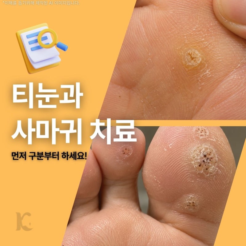 광주 티눈제거 발바닥 사마귀치료 수완지구에서 살펴보는 재발 관련 궁금증