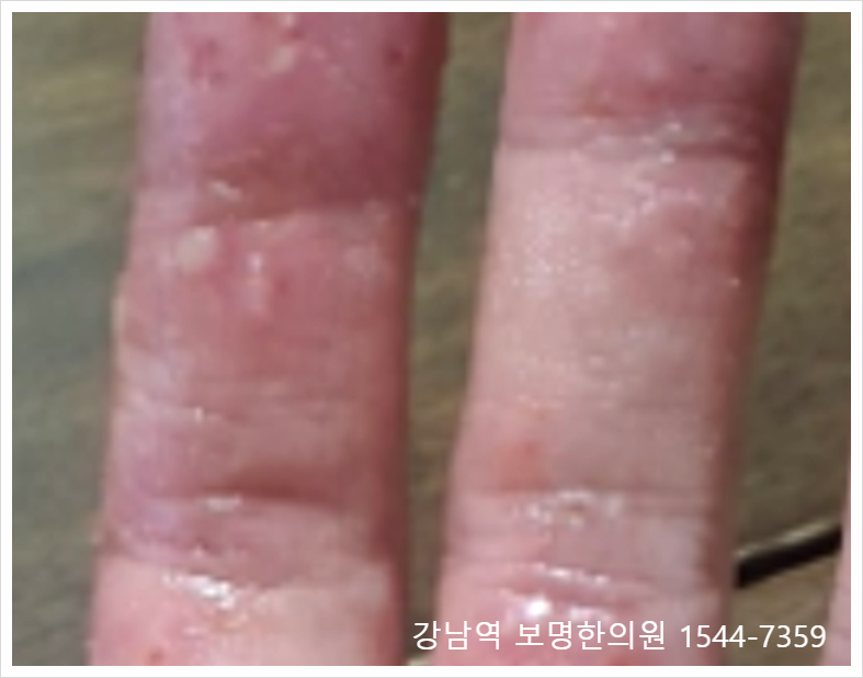 손가락 수포 원인 한포진일까? 사마귀일까?