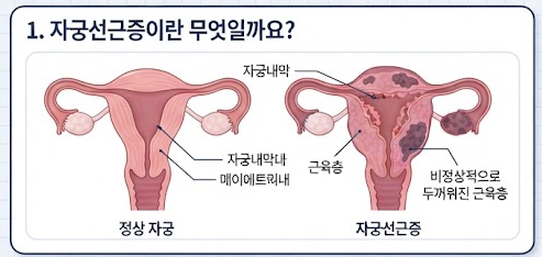 심해진 생리통과 출혈, 자궁선근증일까?