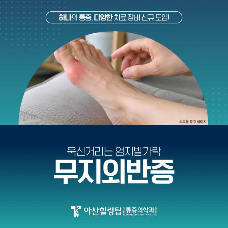 다양한 무지외반증 치료, 산본정형외과와 알아보세요