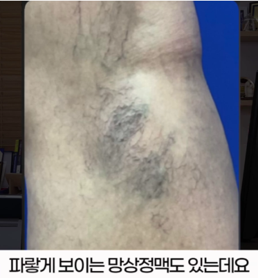 허벅지 하지정맥류일까? 핏줄 보이는 위치부터 확인하세요