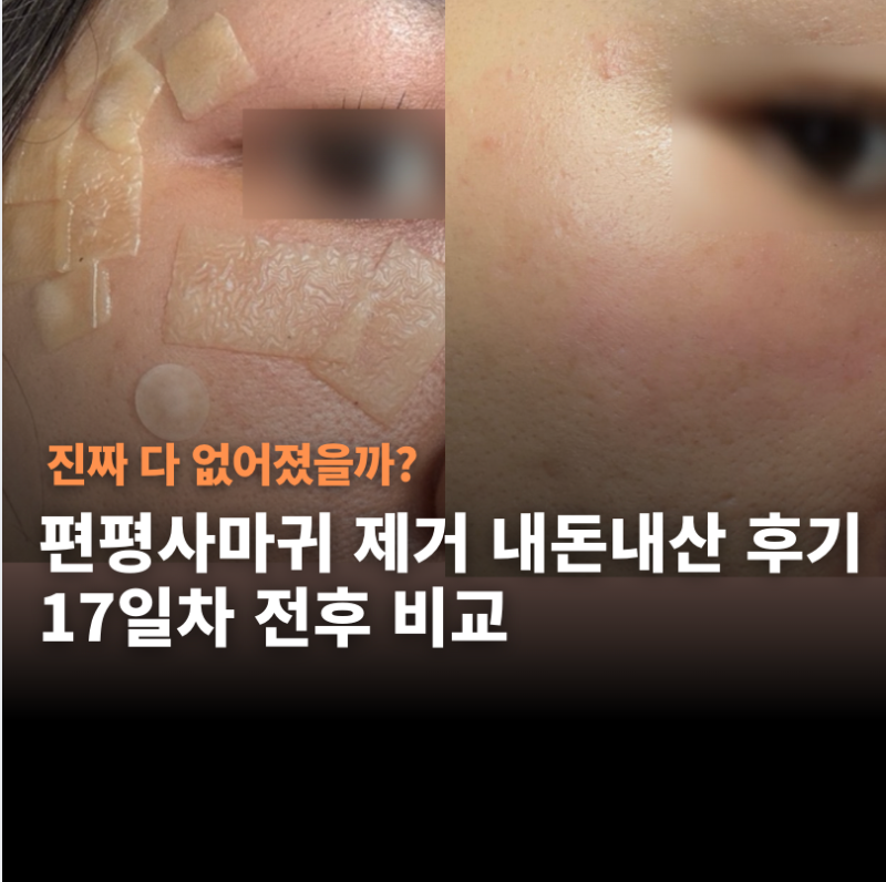 편평사마귀 제거 16일차 후기 | 화장 언제부터? 제거 후 관리 주의사항 (+재발, 무제한 성지)