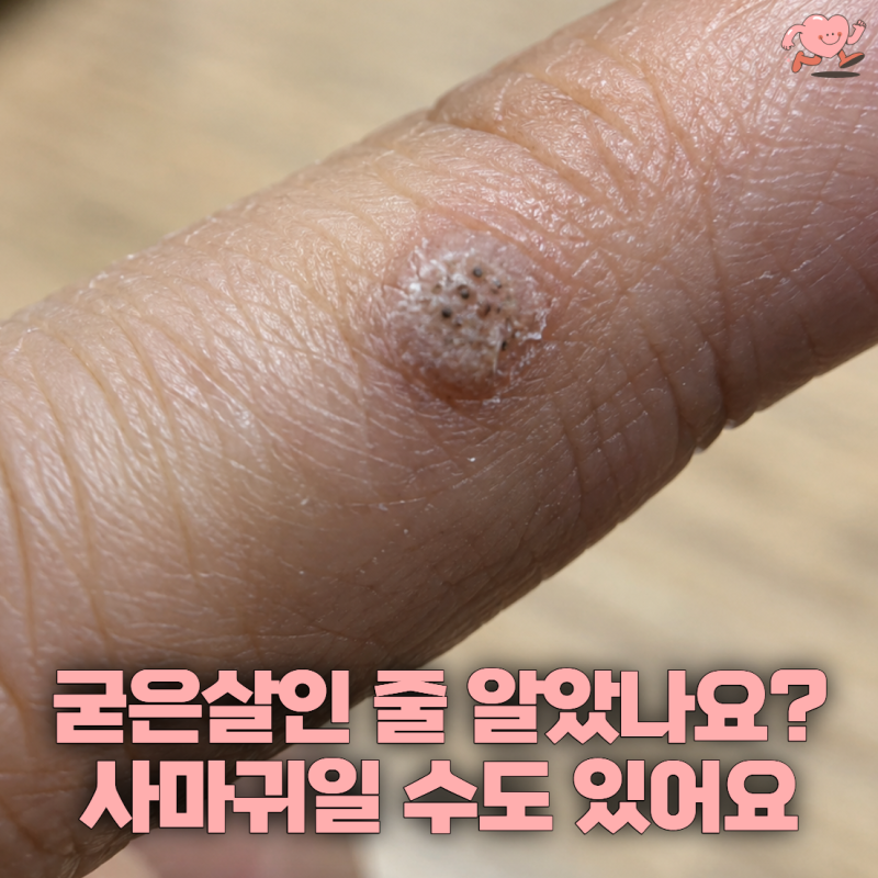“굳은살인 줄 알고 뜯었는데 또 생겼어요” 손가락에 검은 점까지 보인다면 사마귀?