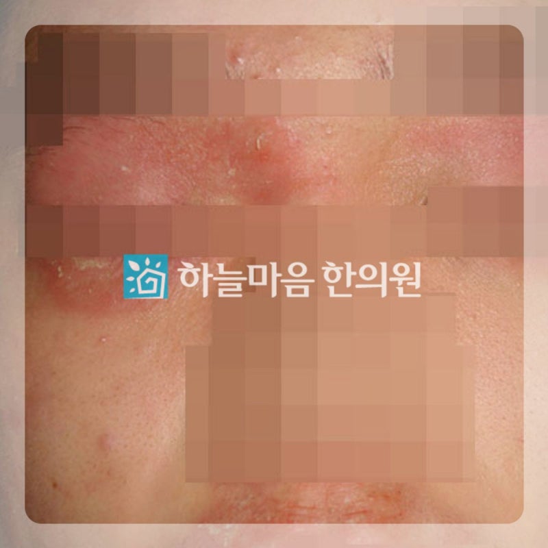 강남아토피 눈가 건조함과 가려움의 원인은?