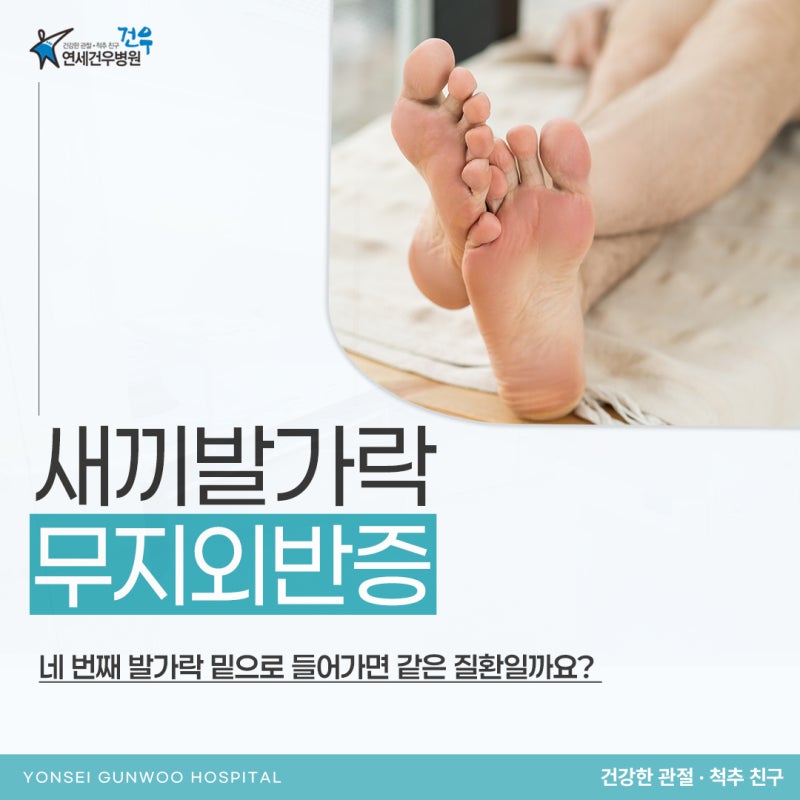 새끼발가락 무지외반증 네 번째 발가락 밑으로 들어가면 같은 질환일까요?