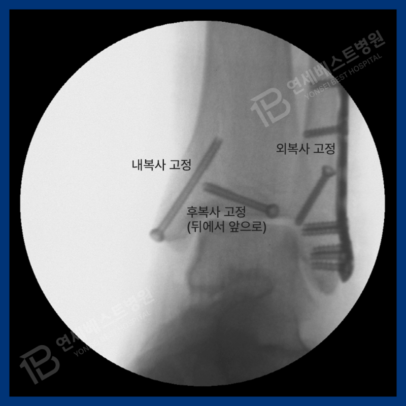 발목 삼복사(삼과)골절 치료, 수술방법과 재활과정