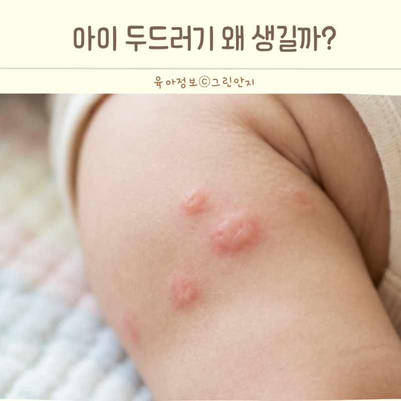 아기 두드러기 원인 갑자기 올라왔다면 음식부터 의심하지 마세요