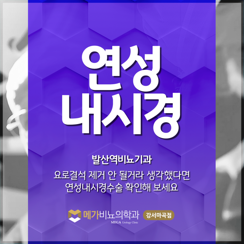 요로결석 제거 안 될거라 생각했다면, 발산역비뇨기과 연성내시경수술 확인해 보세요