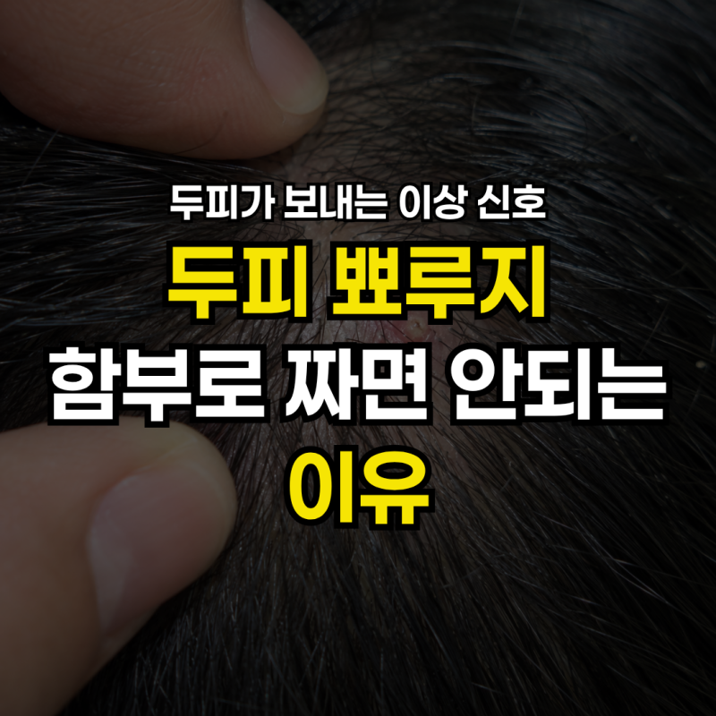 두피 뾰루지 자꾸 생기는 이유 5가지, 여드름처럼 짜면 안 됩니다
