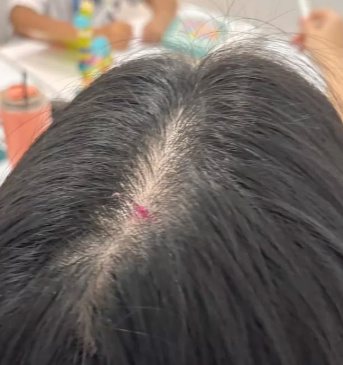 두피 뾰루지 연고 써도써도 해결 안된다면? 유일한 방법