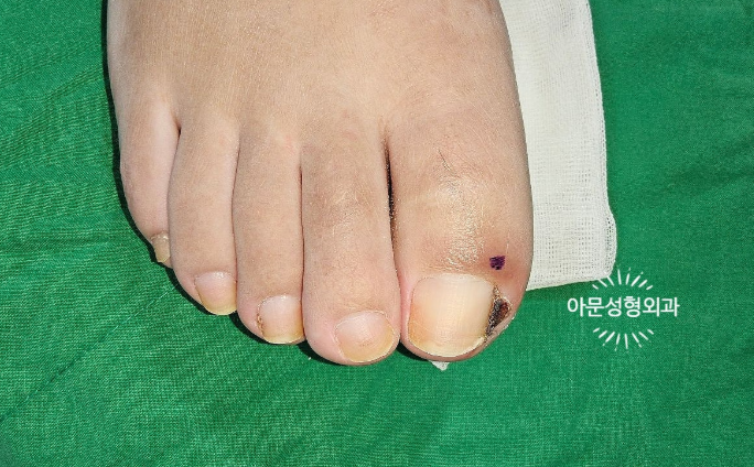 내성발톱, 전기소작술을 선택해야 하는 경우는? 재발성 내성발톱 치료법 (서울 강동구 아문....