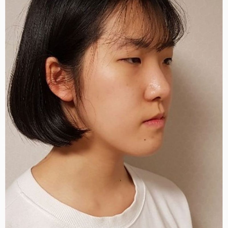저는 주걱턱 교정에 실패했습니다. 재교정 후기