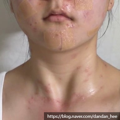 서울 건대 편평사마귀 성지 무제한 내돈내산 후기 (추천 비추 느낀점)