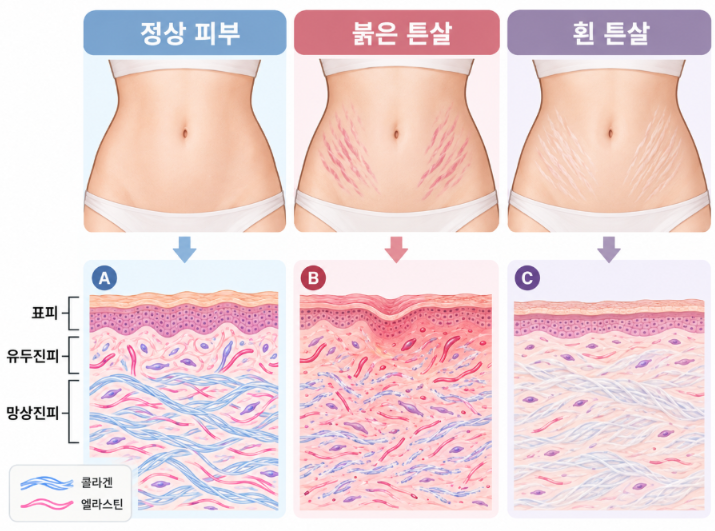 청주복대동피부과, 붉은 튼살과 하얀 튼살은 왜 치료가 달라질까요? I 진료과목 피부과