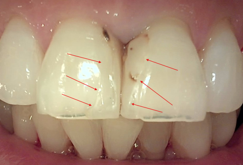 여의도 치과 에서 알려드리는, 앞니 레진 치료 (Diastema) 의 과정