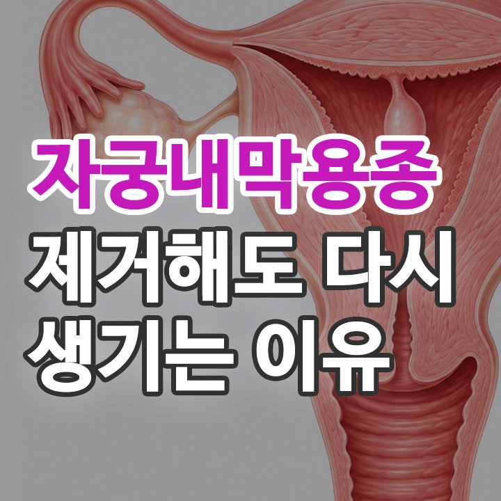 자궁내막용종 원인과 증상 제거해도 다시 생기는 이유