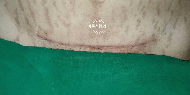 제왕절개 켈로이드 주사 치료, 필요한 경우는? (서울 강동구 아문성형외과) 복부 비후성 반흔....