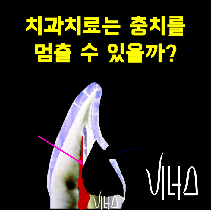 [압구정 앞니전문치과 비너스]자꾸 재발되는 앞니 충치의 단계별 치료