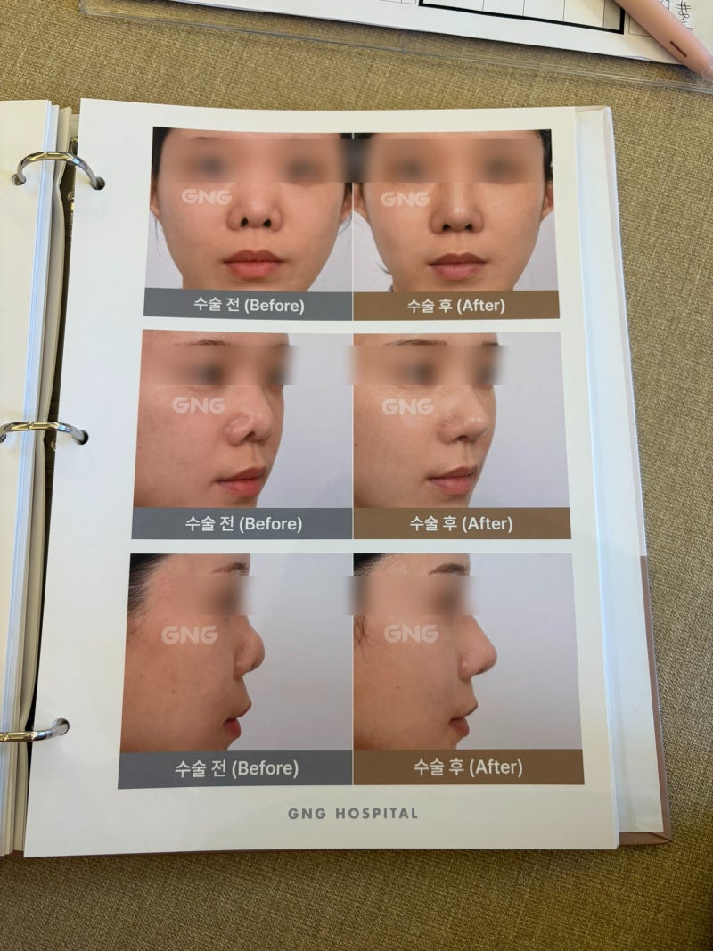 정복술은 어디서 하는게 좋을까? 이비인후과 전문의가 수술하는 코수술 병원은? 기능코 + 미....