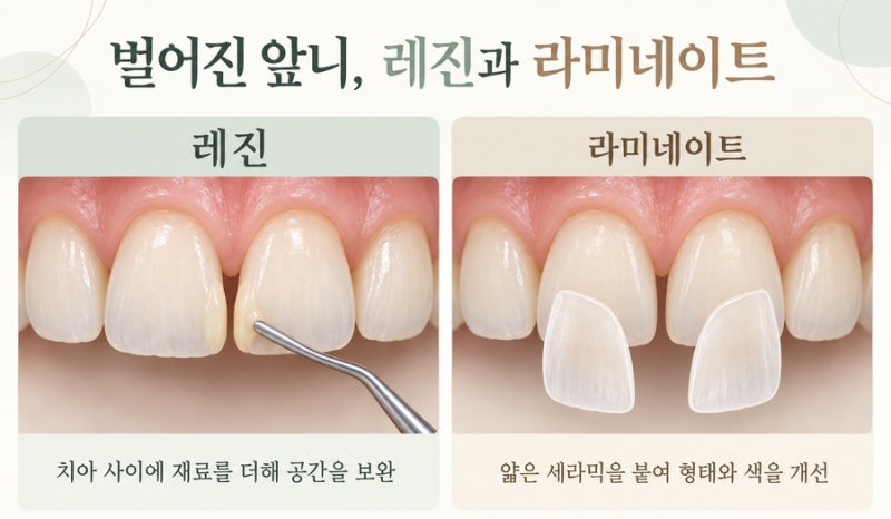 [수완지구 치과] 벌어진 앞니, 레진으로 메울까요? 라미네이트를 해야 할까요?